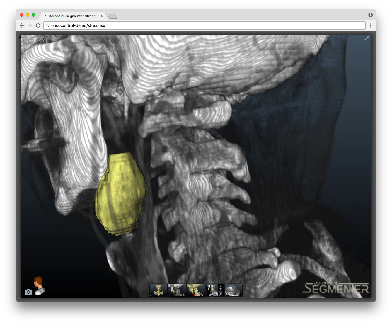 OncoControl – web-based clinical decision support system for head and neck oncology