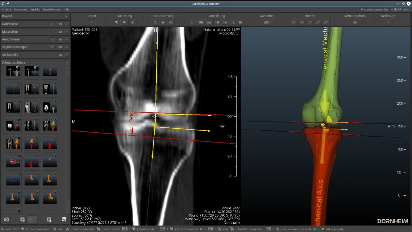 OptiKneeBM – software-based expert system for individual guide design for knee implants