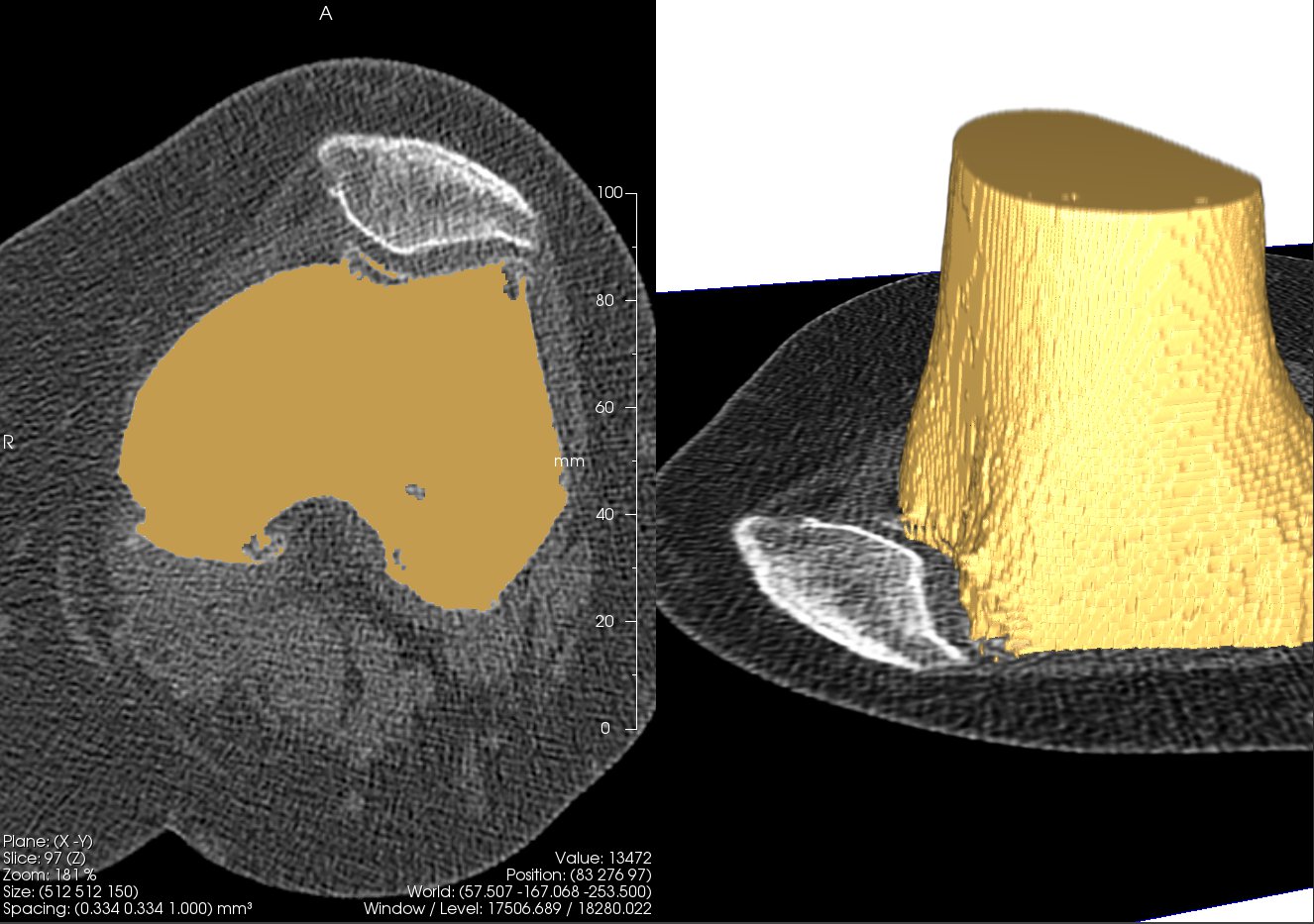 3D surface model of the femur reconstructed from the CT data