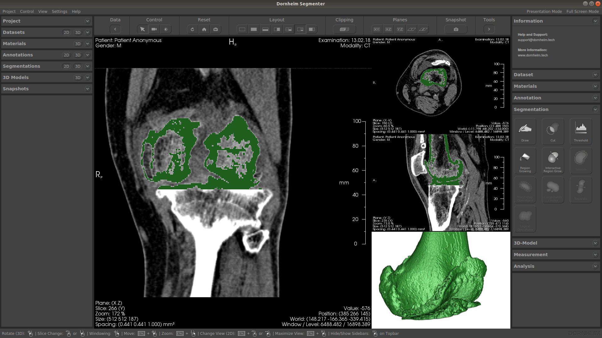 Automated 3D segmentation of the femur at the knee joint from CT data in the Dornheim Segmenter